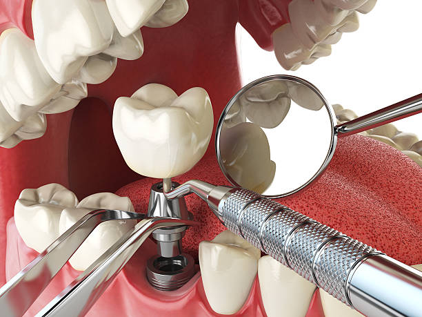 Best Emergency Root Canal Therapy in Canal Winchester, OH